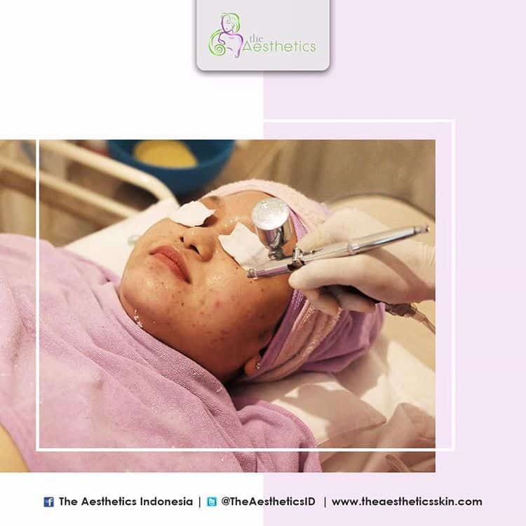 Jajal Treatment Vampir di The Aesthetics Skin Clinic