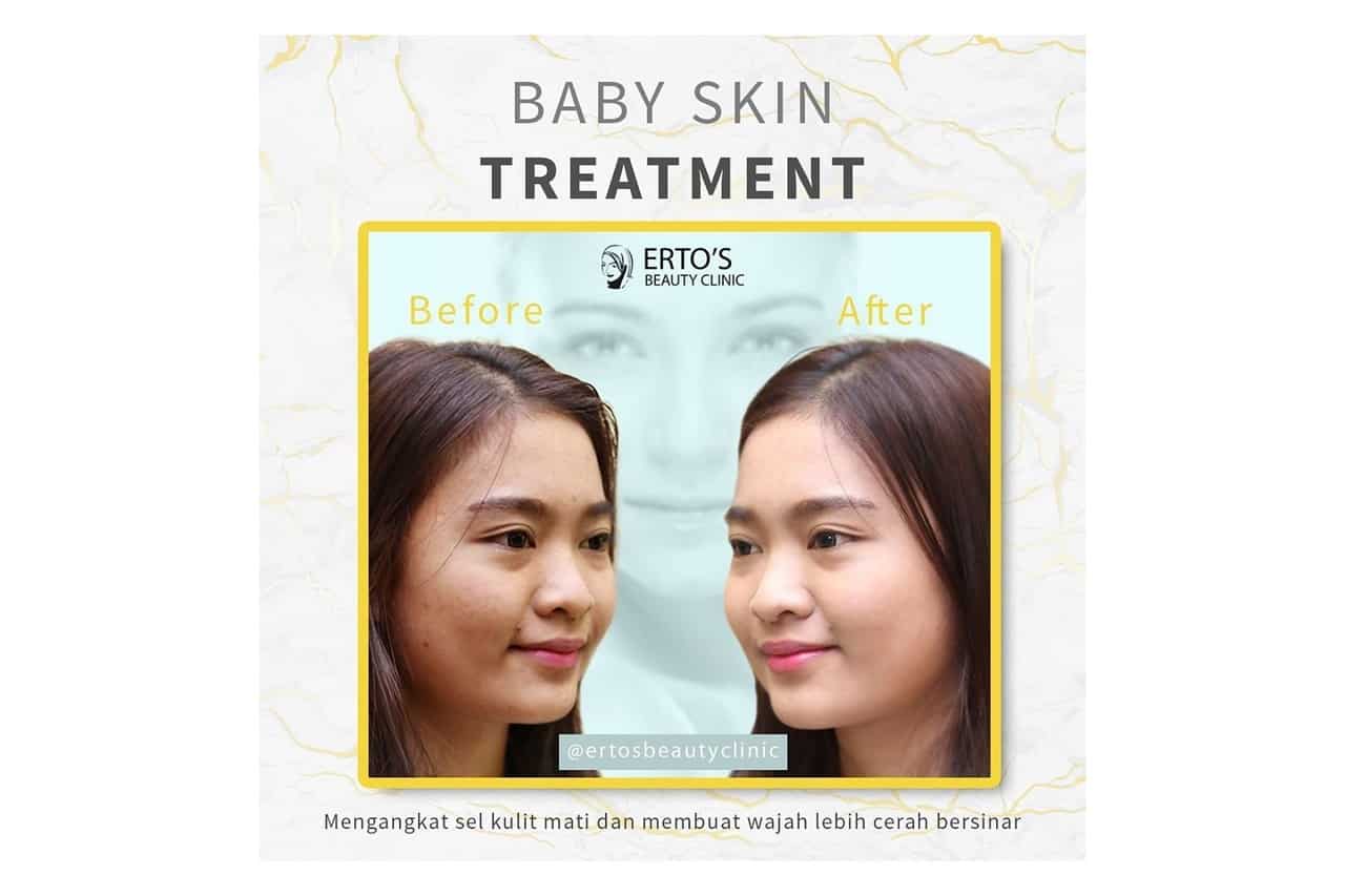 Rawat Wajah dengan Baby Skin Treatment di Ertos Beauty Clinic